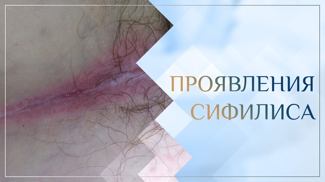 💣 Проявления сифилиса. Клинический случай №19