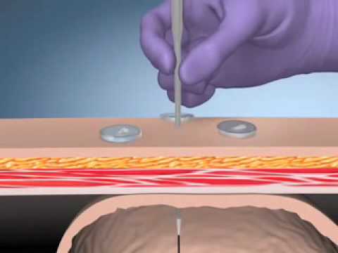 Kimberly-Clark MIC* G Introducer Kits - Radiologic Placement