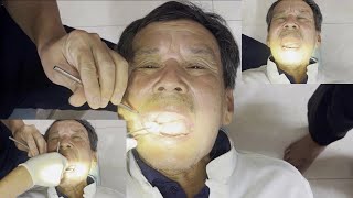 bọc răng sứt để bệnh nhân ăn tốt hơn không còn khó chịu