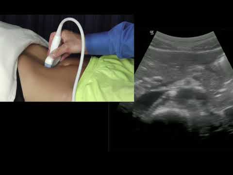 Aorta and IVC US anatomy and measuring