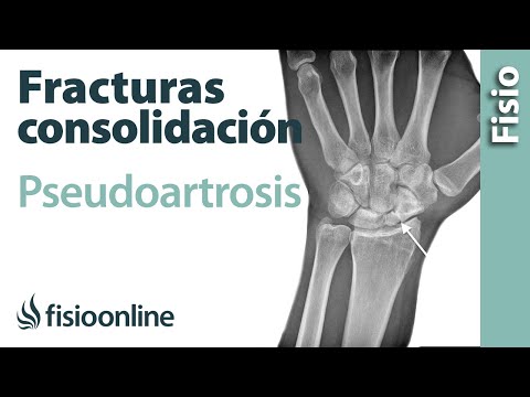 Se è possibile ripristinare la lubrificazione del giunto Escrescenze sulle articolazioni delle dita che