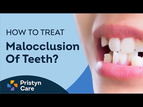 What is Malocclusion of Teeth? | How to Treat Malocclusion?