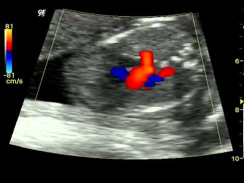Large Right Atrium- Fetal Heart at 19 Weeks
