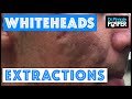 Whitehead extractions on a patient with improving acne