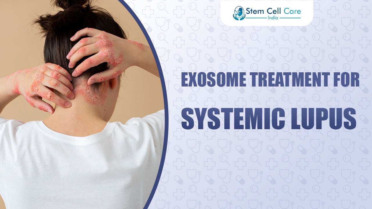 How Exosomes Help Treat Systemic Lupus (SLE) | Benefits, Science & Safety