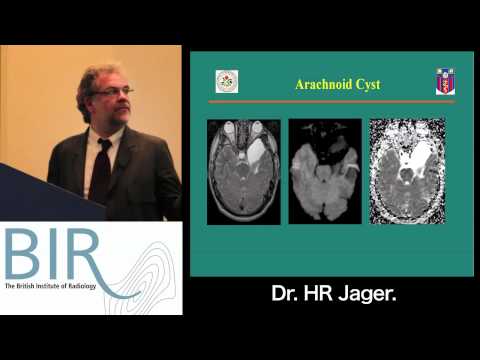 East of England Branch Neuroradiology Study Day: The Value of DWI