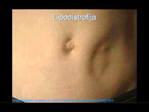 Zdravljenje z insulinom