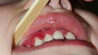 How do I fix a canker sore?