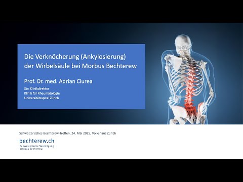 Die Verknöcherung (Ankylosierung) der Wirbelsäule bei Morbus Bechterew