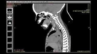 9 Tracheal web