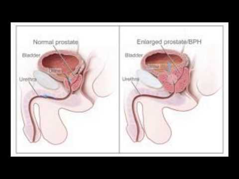 Il sangue della prostata negli uomini Della prostata per cui lanalisi
