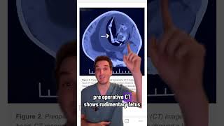 Incredible fetus-in-fetu