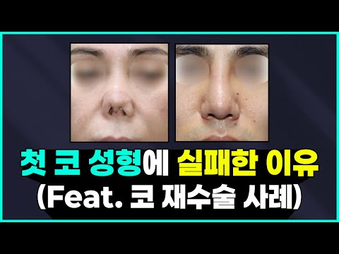 구축코 ... 재수술만 한다고 나아질까요? 첫 코성형 이후 부작용 & 예방과 치료 방법 ✅