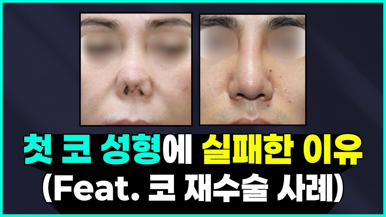 구축코 ... 재수술만 한다고 나아질까요? 첫 코성형 이후 부작용 & 예방과 치료 방법 ✅