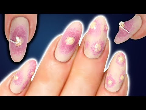 Triderm na may fungus sa pagitan ng toes Halamang-singaw sa iyong mga paa hanggat maaari upang mahuli