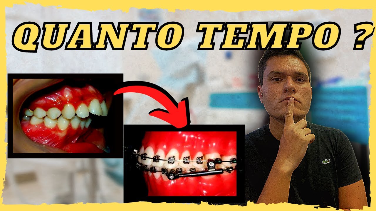 CLASSE 2 EM ORTODONTIA |  DENTE MUITO PARA FRENTE | QUANTO TEMPO LEVA PARA CORRIGIR COM APARELHO