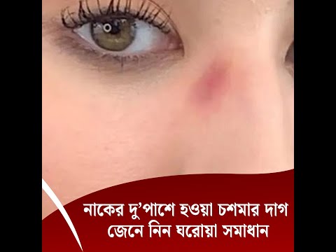 নাকের দু’পাশে হওয়া চশমার দাগ - জেনে নিন ঘরোয়া সমাধান