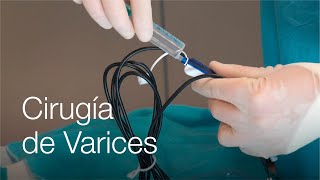 Operación de varices: ¿qué riesgos tiene ¿Cómo es el postoperatorio