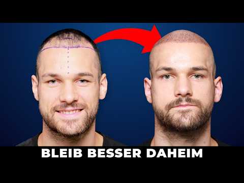 Hair transplant in Turkey - honest opinion