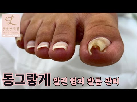 관리가 두려워서 미루다 미루다 방문하신 고객님..!  #풋풋한리쌤 #풋풋한리쌤평내호평점 #파고드는발톱관리
