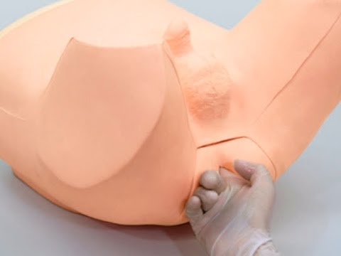 Flüssigkeit Samen und Prostata Operation, um Prostatakrebs Effekte zu entfernen