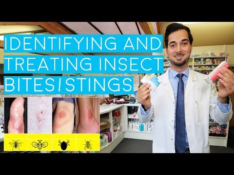 Insect Bites and Stings | Insect Bites Treatment | How to Treat Insect Bites and Stings | 2018