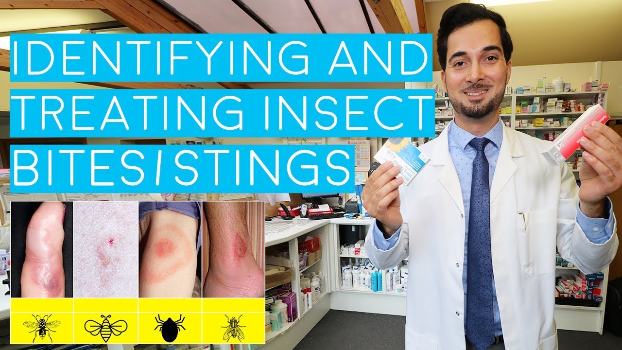 Insect Bites and Stings | Insect Bites Treatment | How to Treat Insect Bites and Stings | 2018