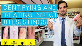 Insect Bites and Stings | Insect Bites Treatment | How to Treat Insect Bites and Stings | 2018