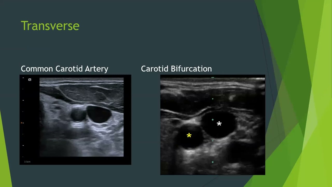 Vascular Imaging Webinar Series: Carotid Ultrasound