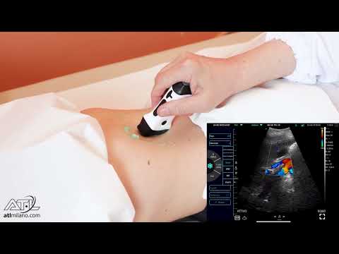 Ecografia Addome (Vie biliari) - Ecografo palmare Wireless CERBERO4.0 B-MatrixSound
