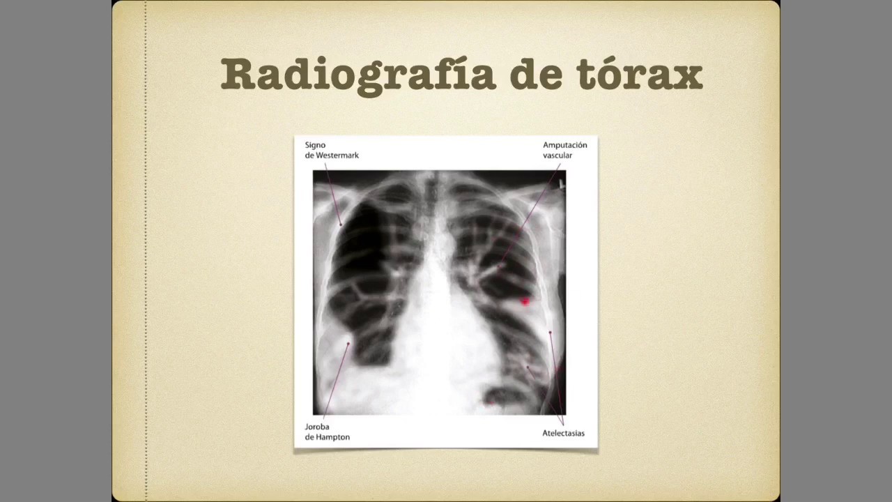 Tromboembolia pulmonar