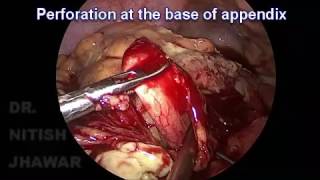 Laparoscopic Appendectomy (perforated appendix, left side appendix)