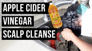 APPLE CIDER VINEGAR SCALP CLEANSE | See How it works 💪