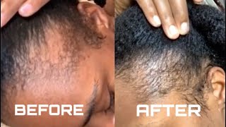 HOW TO REGROW YOUR EDGES WITH CASTOR OIL | FIXING BALD SPOTS