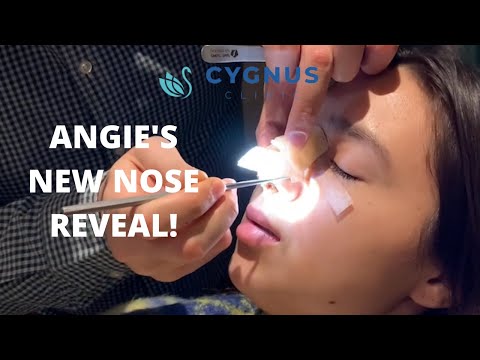 Angie's New Nose Reveal | Rhinoplasty | #CygnusNose
