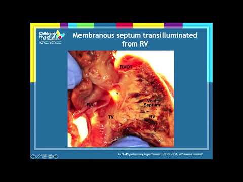 Ventricular Septal Defects : Anatomy and Natural History