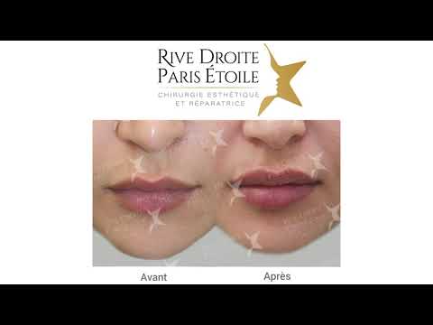 Présentation par le Dr Hunsinger de l'intervention d'augmentation des lèvres par acide hyaluronique à la clinique de chirurgie esthétique Rive Droite Paris Étoile.
