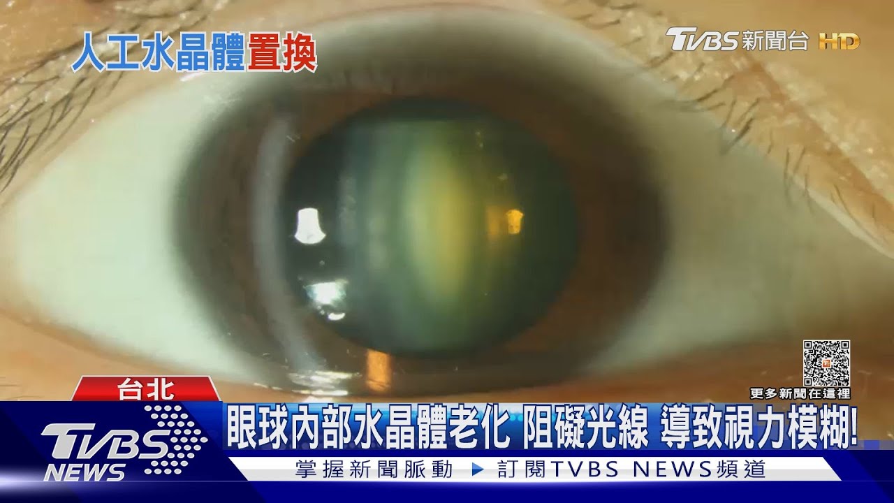 眼睛出現「這狀況」！若不置換人工水晶體　醫師：恐終生失明