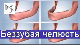 Лечение беззубых челюстей. Ортопедическая стоматология.