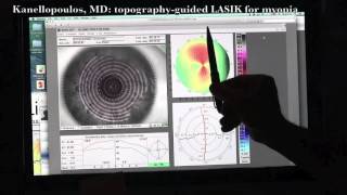 Download Lagu Clinical pearls of 14 years experience with for Topography guided LASIK 2015, ~Kanellopoulos, MD Thumbnail