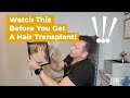 Dr. Max goes over hair transplant mistakes done by a previous surgeon on this patient, and how he had corrected them.