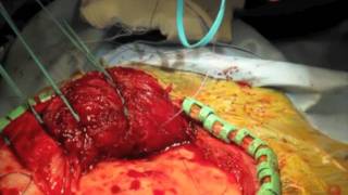 Temporal Craniotomy HD