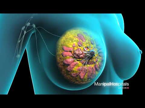 Surgical Procedure For Breast Removal | Lumpectomy Surgery | Mastectomy - Manipal Hospital