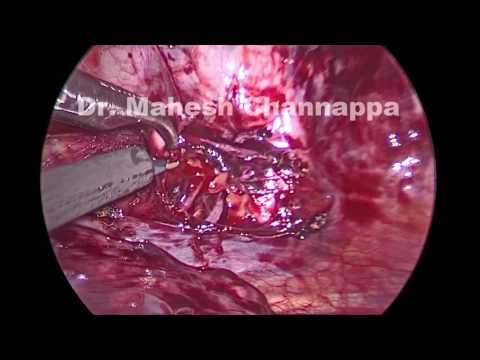 Sweaty Palms ,VATS surgery