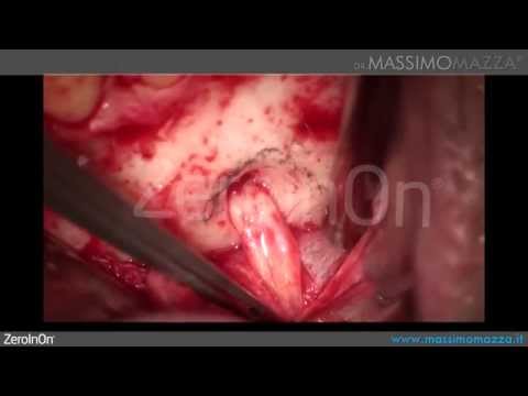 Odontogenic Mandibular Cyst