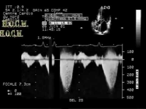 Hypertrophic Obstructive Cardiomyopathy (HOCM)