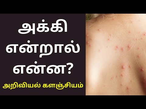 அக்கி  அம்மை நோய் என்றால் என்ன? |Shingles Herpes simplex in tamil | அறிவியல் களஞ்சியம்