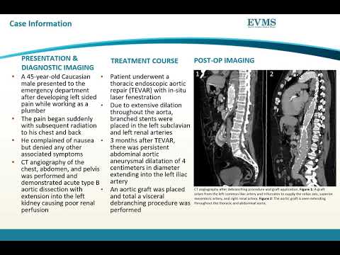 Thumbnail image of video presentation for A rare case of Loeys-Dietz: A radiologist's perspective