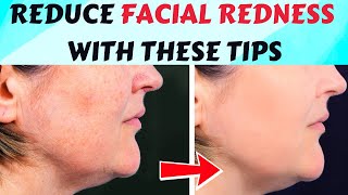 3 Effective Tips to Get Rid of Redness on Face Easily !! ✅