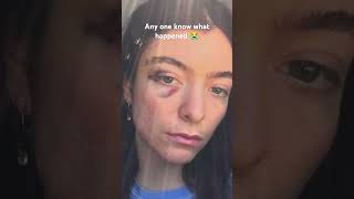 What happened 😭 #lorde #lordefan #music #singer